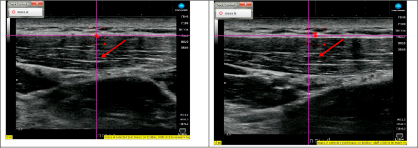 the deep fascia displacement